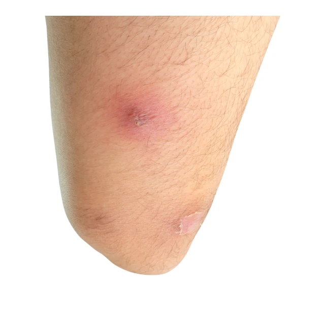 Inflamed red skin bump and lesion on human leg